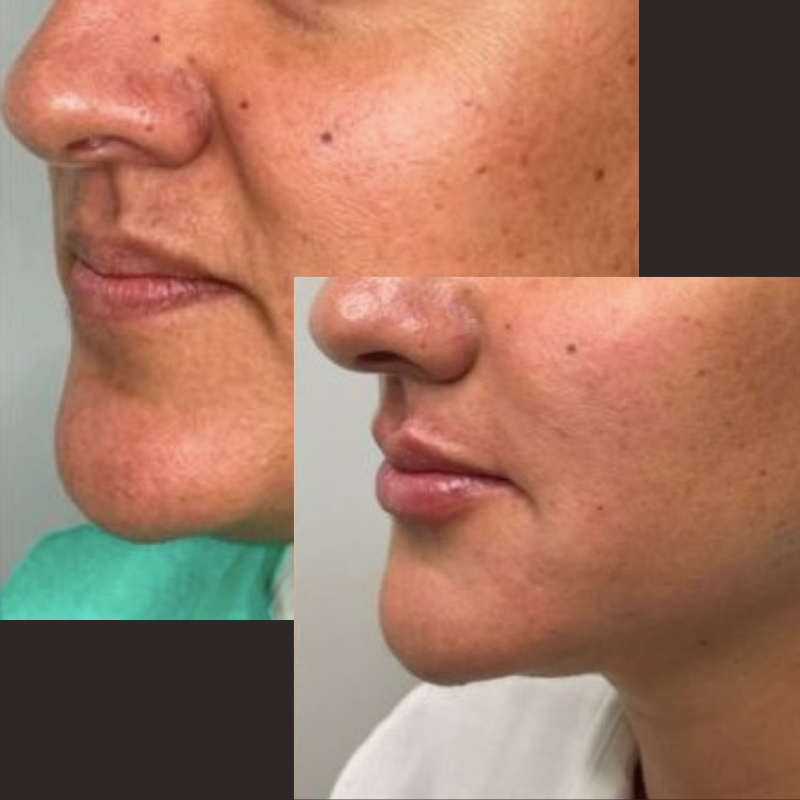 Rejuvecimiento facial